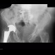 Fracture of pelvis, old: X-ray - Plain radiograph